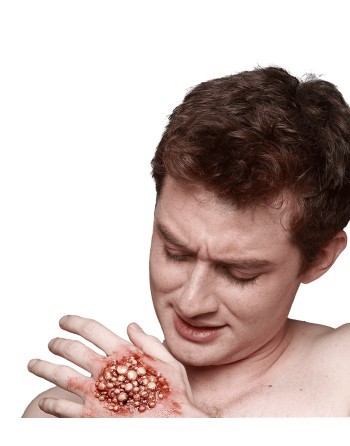 Appliance - itchy wound