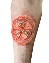 Radioactive wound